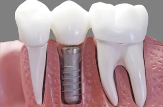 Dental implant problem