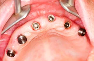 immediate dental implants