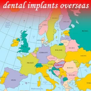 dental implants overseas