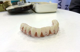 Dental prothese dental dentures
