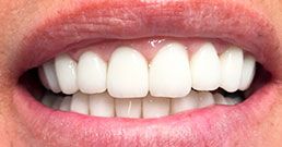 Hollywood smile crowns Hollywood smile crowns