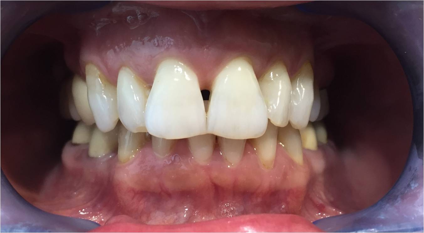 Teeth veneers before and after teeth veneers before and after