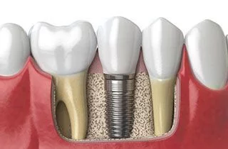 best-place-to-get-dental-implants