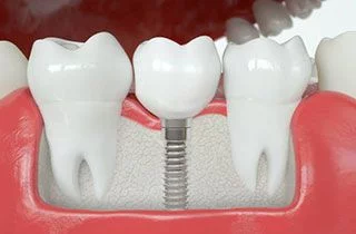 reversing bone loss in teeth
