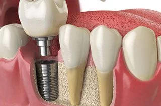 Diabetic dental implants