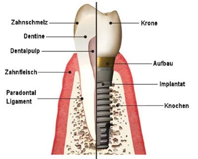 Cheap dental implants