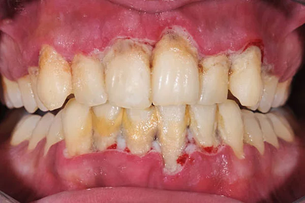 dental-plaque
