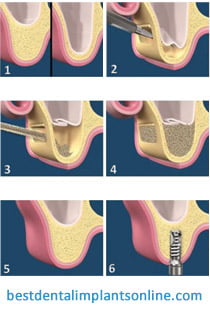 Sinus lift - What exactly is this surgical procedure? BestDentalImplants