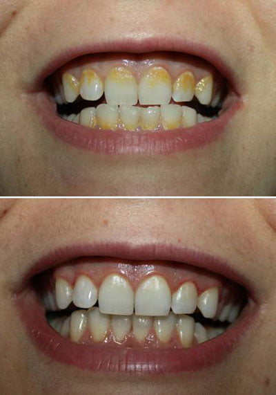 dental plaque before-after