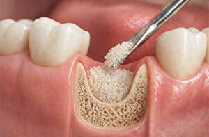 Autogenous Bone Graft From Own Teeth